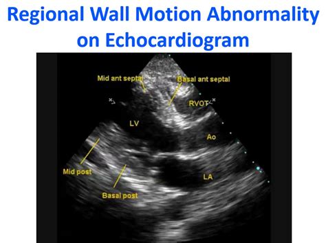 wall motion abnormalities echo.